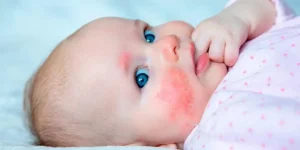 علائم حساسیت نوزاد به شیر خشک